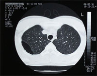 嚢胞性肺疾患のCT